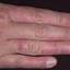 315. Dry Eczema on Hands Pictures