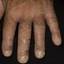 317. Dry Eczema on Hands Pictures