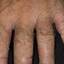 318. Dry Eczema on Hands Pictures