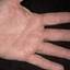 321. Dry Eczema on Hands Pictures