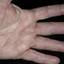 322. Dry Eczema on Hands Pictures