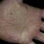 323. Dry Eczema on Hands Pictures