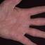 326. Dry Eczema on Hands Pictures