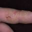 327. Dry Eczema on Hands Pictures