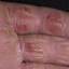 331. Dry Eczema on Hands Pictures