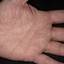 333. Dry Eczema on Hands Pictures