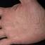 334. Dry Eczema on Hands Pictures