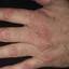335. Dry Eczema on Hands Pictures