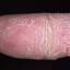 338. Dry Eczema on Hands Pictures