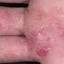 339. Dry Eczema on Hands Pictures