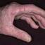 341. Dry Eczema on Hands Pictures