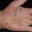 346. Dry Eczema on Hands Pictures