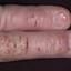 352. Dry Eczema on Hands Pictures