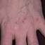 354. Dry Eczema on Hands Pictures