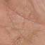 357. Dry Eczema on Hands Pictures