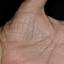 360. Dry Eczema on Hands Pictures