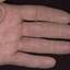 361. Dry Eczema on Hands Pictures