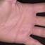 362. Dry Eczema on Hands Pictures