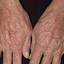 363. Dry Eczema on Hands Pictures