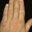 372. Dry Eczema on Hands Pictures