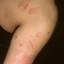385. Dry Eczema on Hands Pictures
