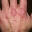 387. Dry Eczema on Hands Pictures
