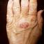 390. Dry Eczema on Hands Pictures
