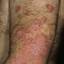 393. Dry Eczema on Hands Pictures
