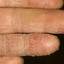 40. Dry Eczema on Hands Pictures