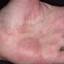 402. Dry Eczema on Hands Pictures