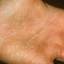 425. Dry Eczema on Hands Pictures