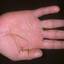 426. Dry Eczema on Hands Pictures