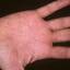 428. Dry Eczema on Hands Pictures