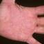 429. Dry Eczema on Hands Pictures