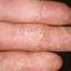43. Dry Eczema on Hands Pictures