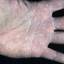 433. Dry Eczema on Hands Pictures
