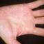 434. Dry Eczema on Hands Pictures