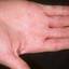435. Dry Eczema on Hands Pictures