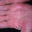 436. Dry Eczema on Hands Pictures