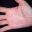 437. Dry Eczema on Hands Pictures