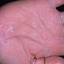438. Dry Eczema on Hands Pictures