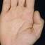 439. Dry Eczema on Hands Pictures