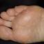 441. Dry Eczema on Hands Pictures
