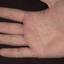 442. Dry Eczema on Hands Pictures