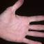 444. Dry Eczema on Hands Pictures