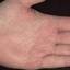 445. Dry Eczema on Hands Pictures