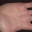 447. Dry Eczema on Hands Pictures