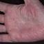 449. Dry Eczema on Hands Pictures
