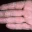 45. Dry Eczema on Hands Pictures