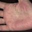450. Dry Eczema on Hands Pictures